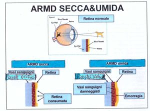 maculopatia secca e umida